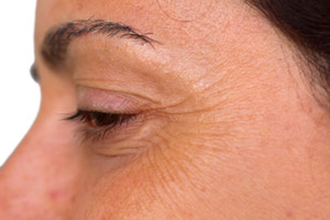 Eyelid Surgery